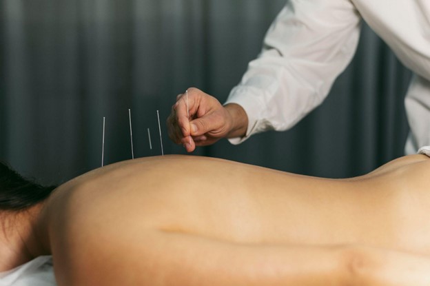 Acupuncture Therapy