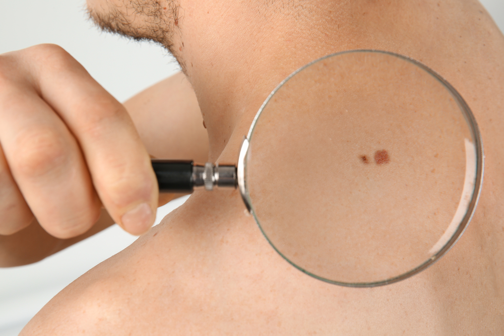What Is Merkel Cell Skin Cancer?