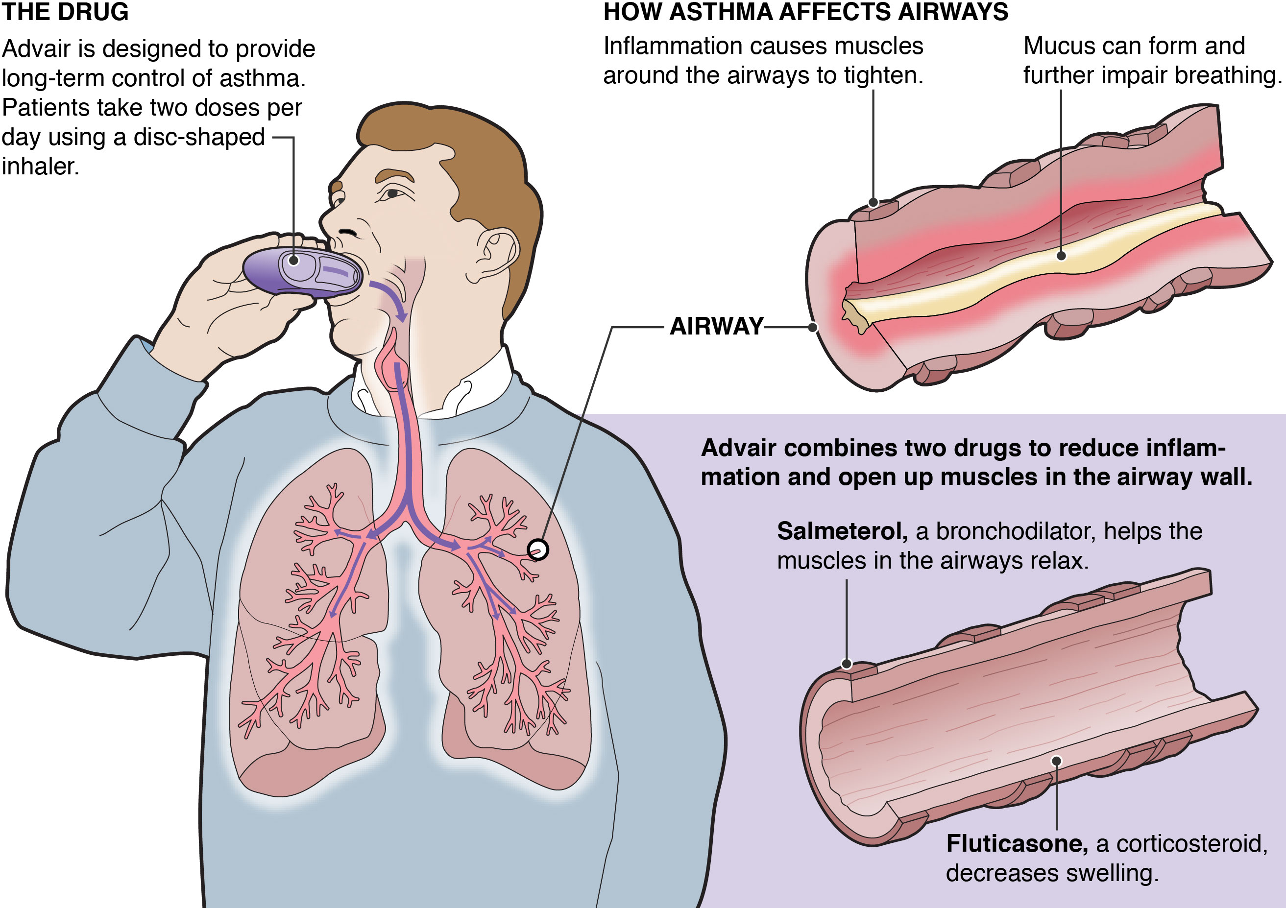 What Is Advair Or Seretide? (fluticasone and salmeterol)