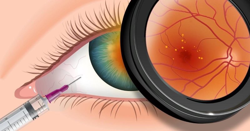 Avastin, Eylea and Lucentis – What’s the Difference?