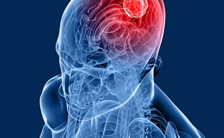 What Is Avastin?(Bevacizumab)