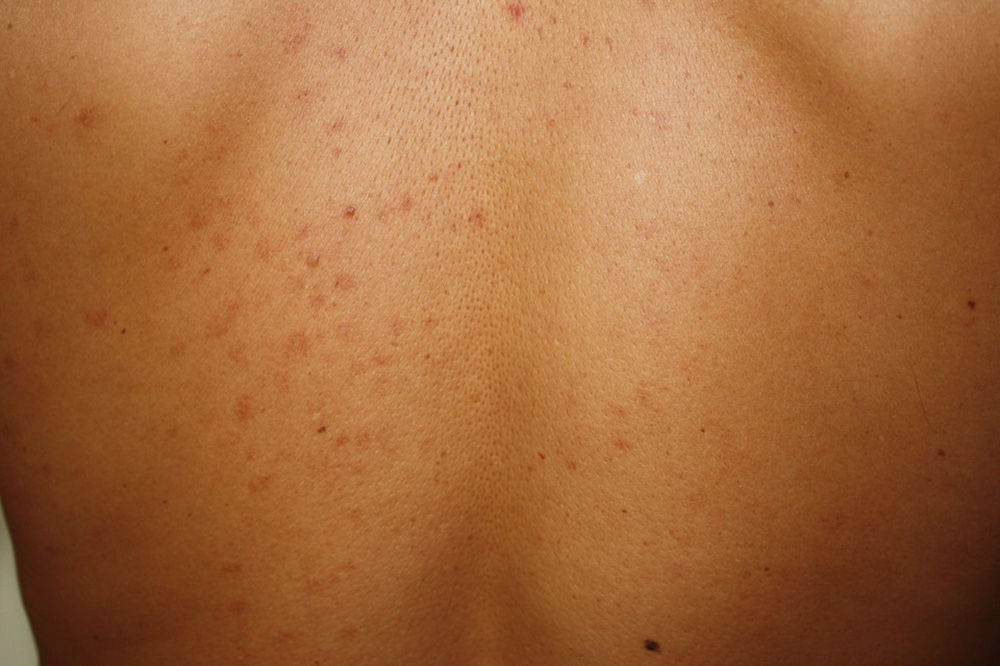 What Is Aggressive Mastocytosis?