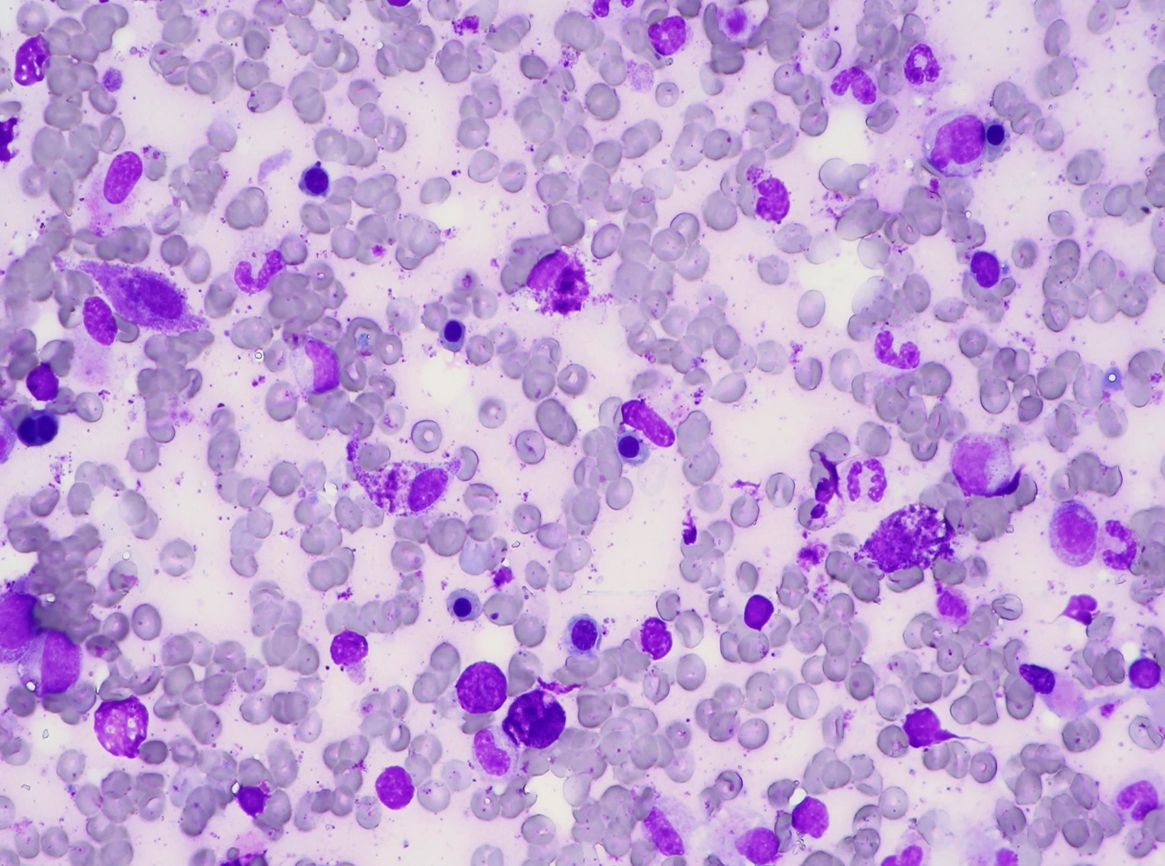 What Is Aggressive Mastocytosis?