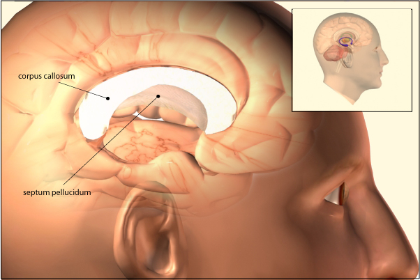 What Is Agenesis Of Corpus Callosum?