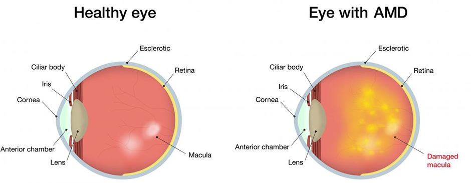 What Is Age-Related Macular Degeneration?