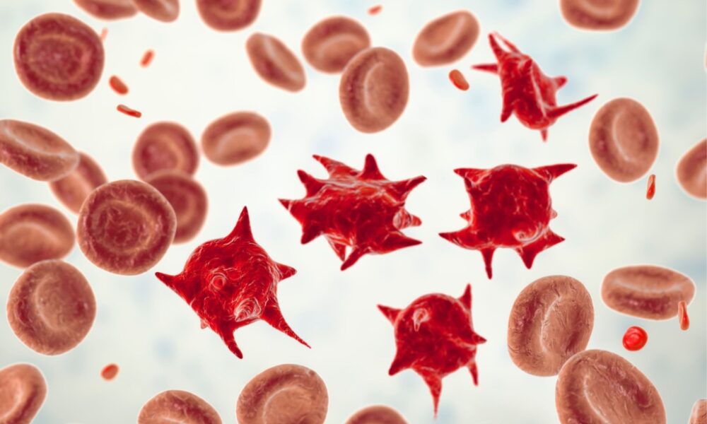 What Is Acanthocytosis?