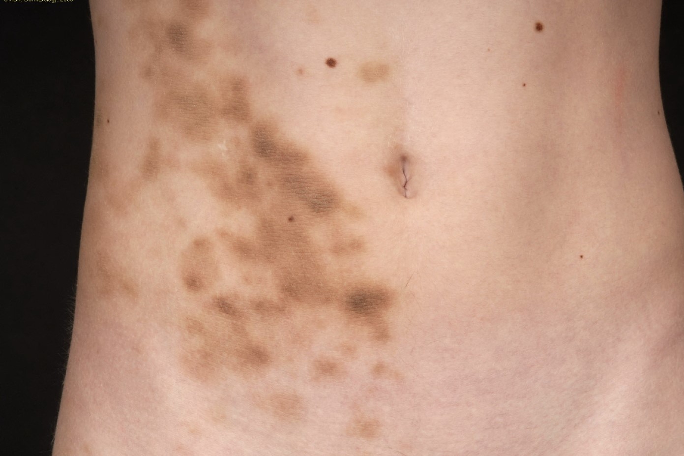 What Is Acanthotic nevus?