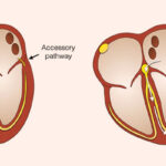 Accessory Atrioventricular Pathways