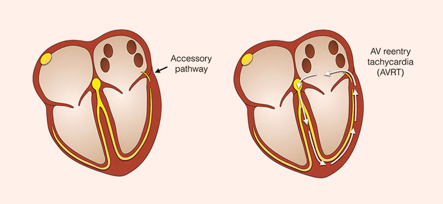 Accessory Atrioventricular Pathways