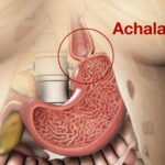Achalasia: Symptoms, Causes & Updated Treatment