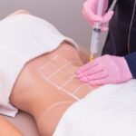 1. Acquired Lipodystrophy: Causes, Symptoms, Diagnosis & Latest Treatment Options