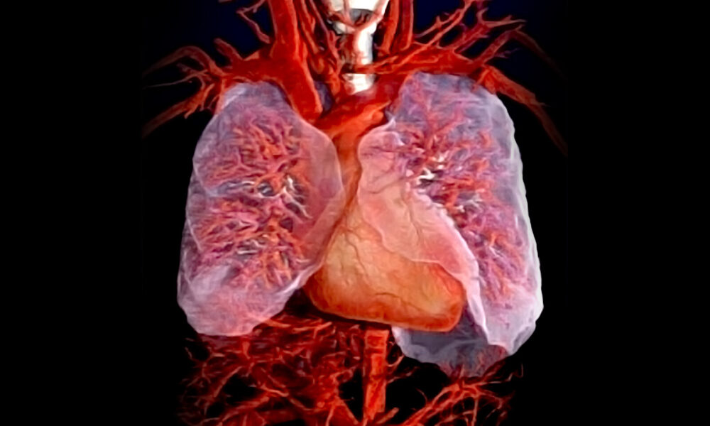 Alveolar Capillary Dysplasia