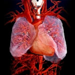 Alveolar Capillary Dysplasia