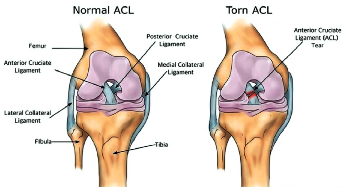 Anterior Cruciate Ligament (ACL)