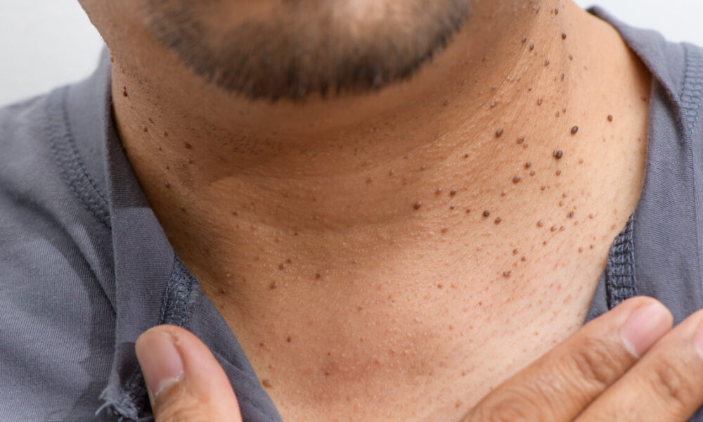 2. What Is Acanthotic Nevus? Distinguishing Seborrheic Keratosis from Skin Cancer