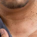 2. What Is Acanthotic Nevus? Distinguishing Seborrheic Keratosis from Skin Cancer