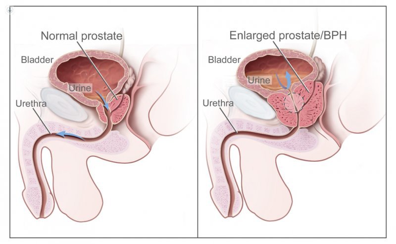 Benign prostatic hyperplasia (BPH)? Causes, Symptoms, Diagnosis And Treatment