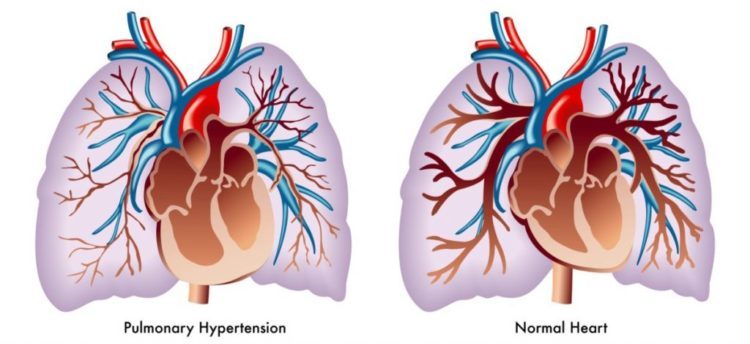 What Is Alveolar capillary dysplasia?