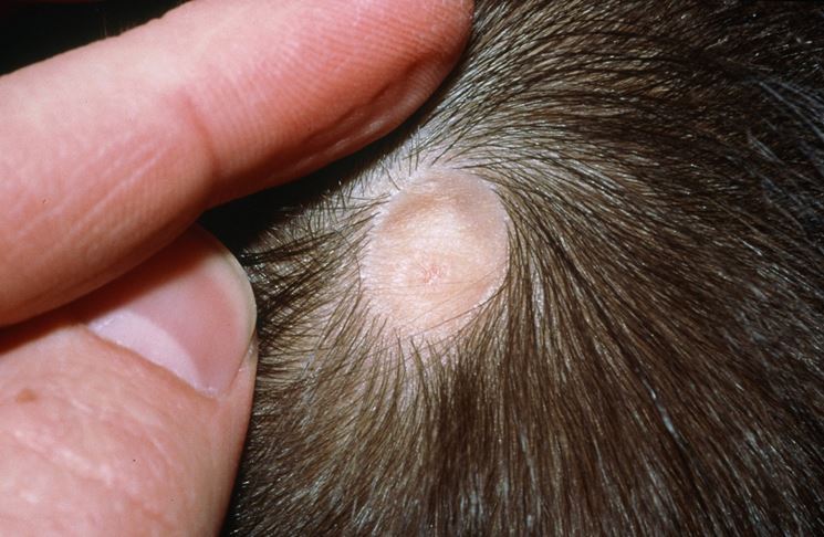 What Is ACC? (Aplasia Cutis Congenita)