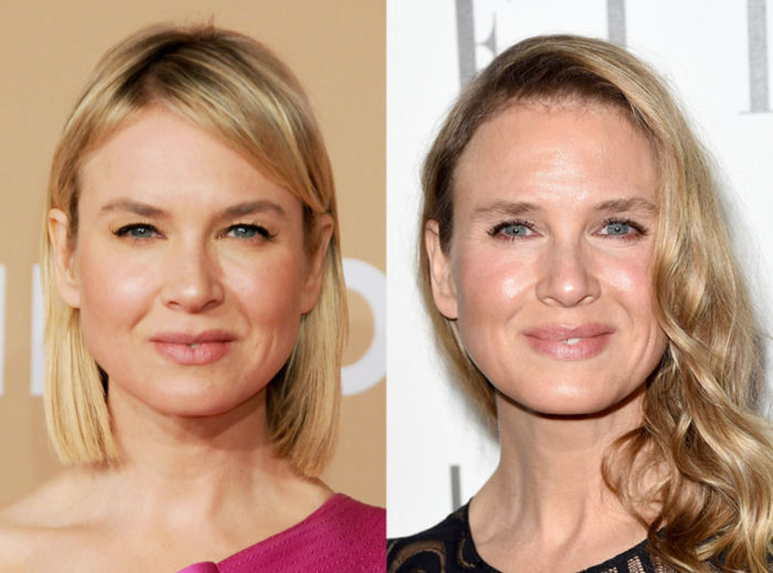 What Is Zellweger Syndrome? What Is Zellweger Syndrome?