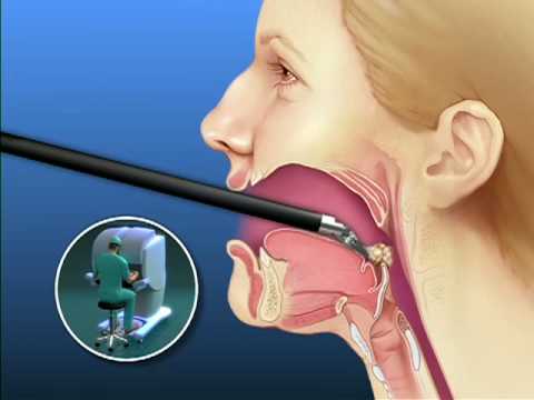 What Is An Adenoidectomy (adenoid removal)? What Is An Adenoidectomy (adenoid removal)?