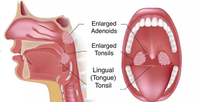 What Is An Adenoidectomy (adenoid removal)? What Is An Adenoidectomy (adenoid removal)?