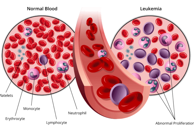 About Acute Lymphocytic Leukemia (ALL)