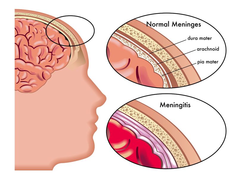 Meningococcal Meningitis: symptoms, Causes And Treatments.