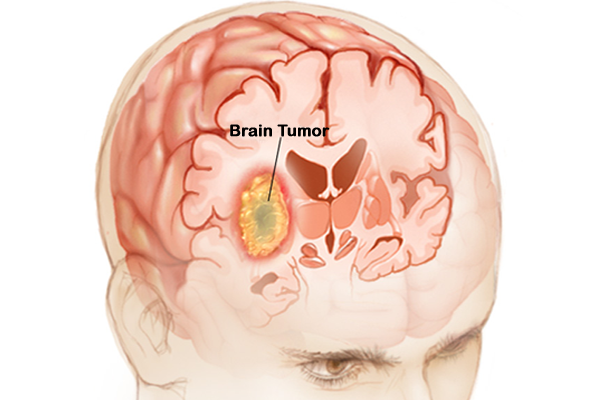 What Is a Brain Tumor?