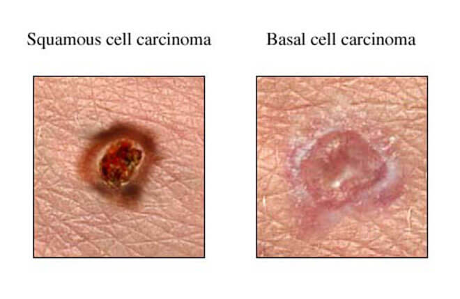 About Basal and Squamous Cell Skin Cancer