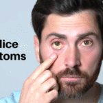 Acholuric Jaundice: Causes, Symptoms, Diagnosis & Treatment