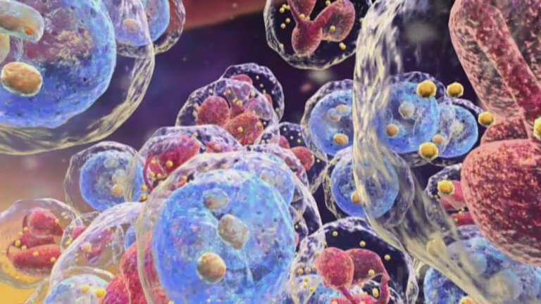 What Is Chronic Myeloid Leukemia (CML)