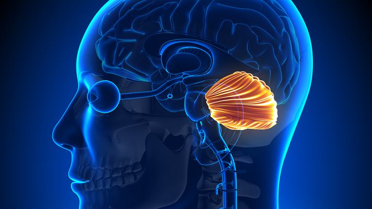 What Is Arnold Chiari Malformation