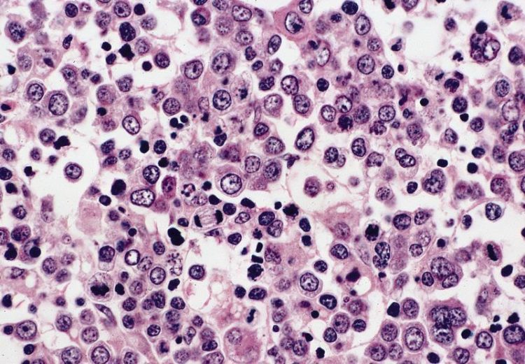 About Congenital Pure Red Cell Aplasia