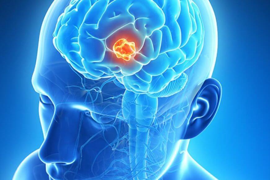 About Brain and Spinal Cord Tumors in Adults