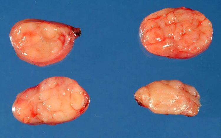 What Is Castleman Disease?