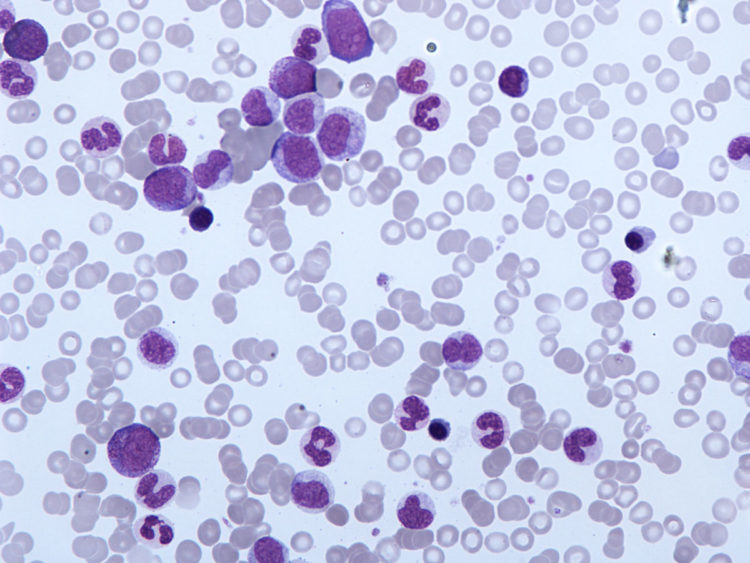 What Is Chronic Myelomonocytic Leukemia (CMML)