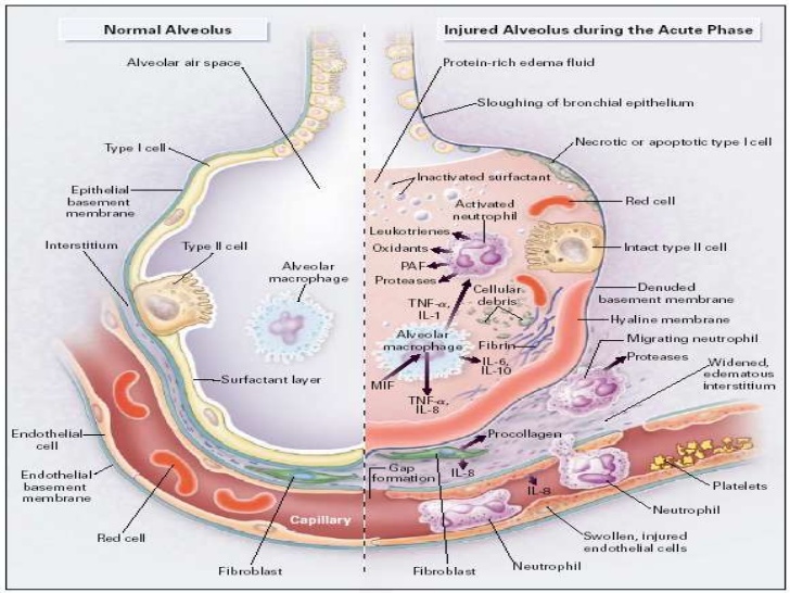 Acute Respiratory Distress Syndrome (ARDS)