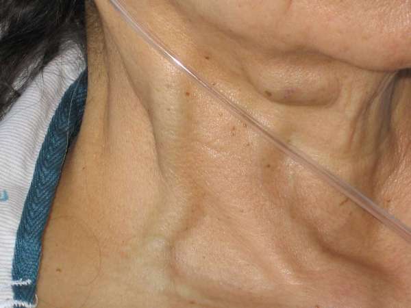 Bilateral Right Sidedness Sequence