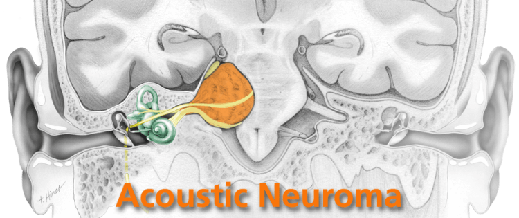What Is Bilateral Acoustic Neuroma?