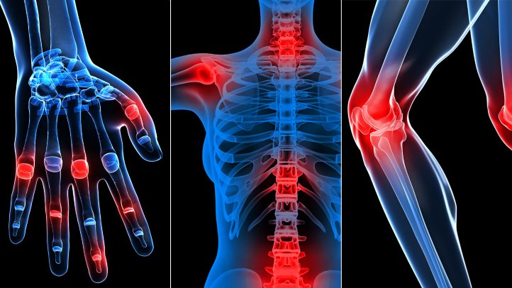 What Is Arthritic Rheumatoid Disease?