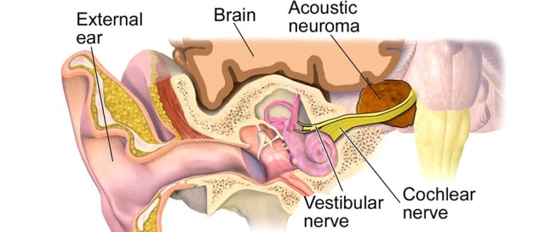 Bilateral Acoustic Neurofibromatosis