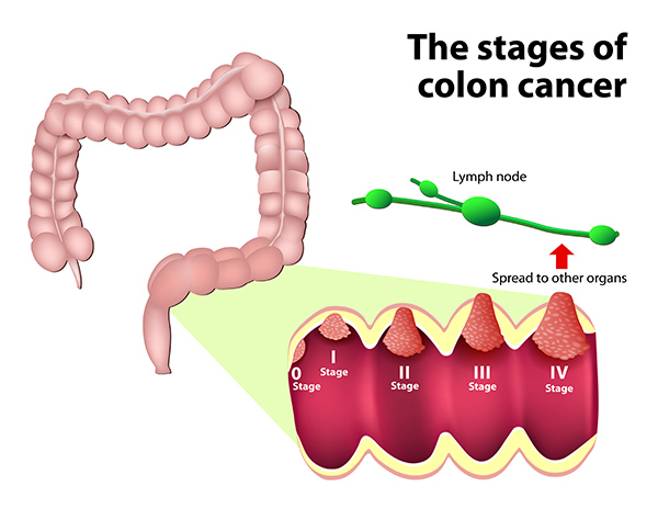 What Is Colorectal Cancer?
