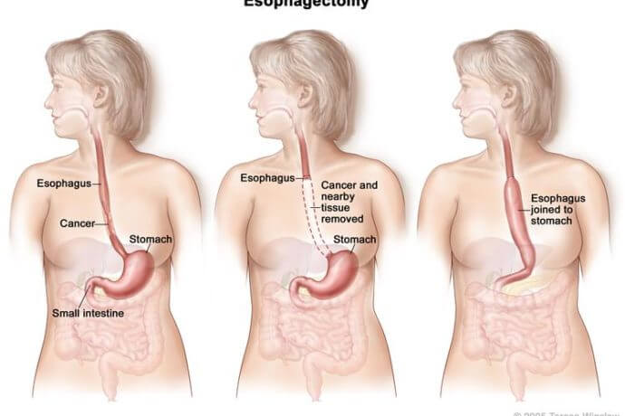 Esophagus Cancer