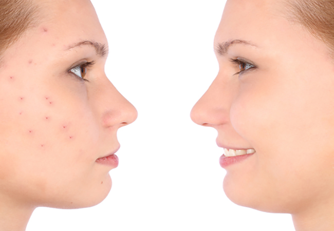 acne and pimple
