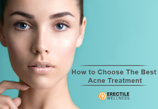 hormonal acne