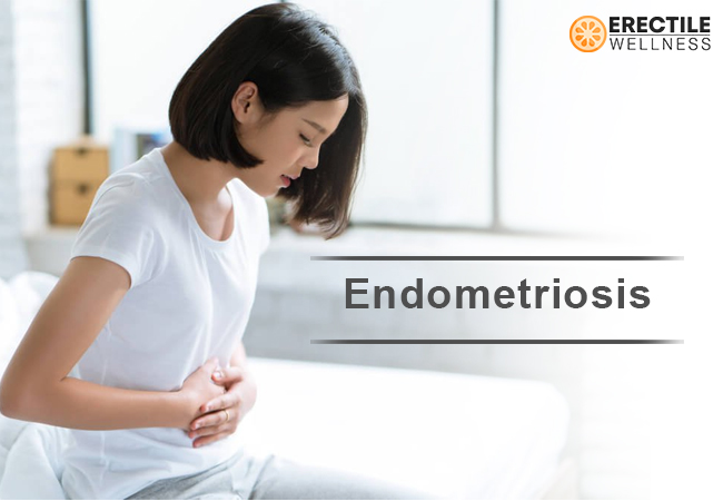 Endometriosis