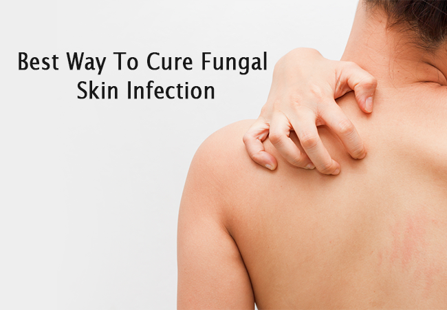 Best Way To Cure Fungal Skin Infection