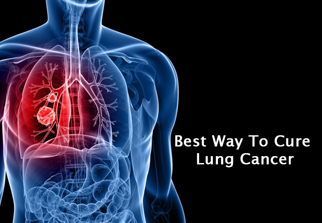 Best Way To Cure Lung Cancer