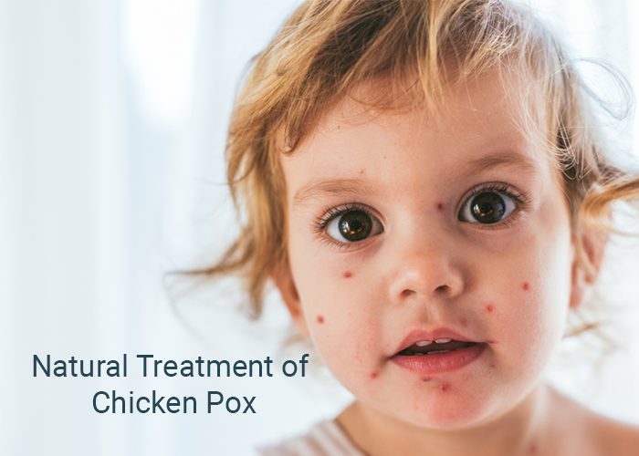Treatment of Chicken Pox